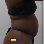 Lipo 360 Before & After Patient #1206