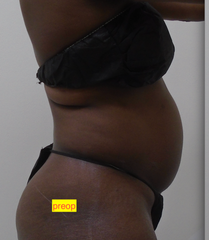 Lipo 360 Before & After Patient #1206