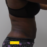 Lipo 360 Before & After Patient #1206