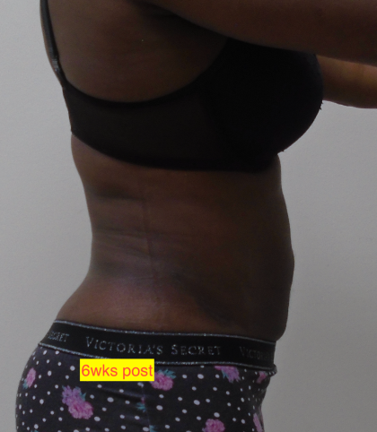 Lipo 360 Before & After Patient #1206