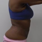 Lipo 360 Before & After Patient #1205