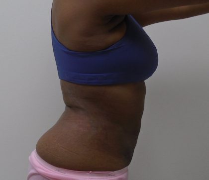 Lipo 360 Before & After Patient #1205