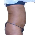 Lipo 360 Before & After Patient #1192
