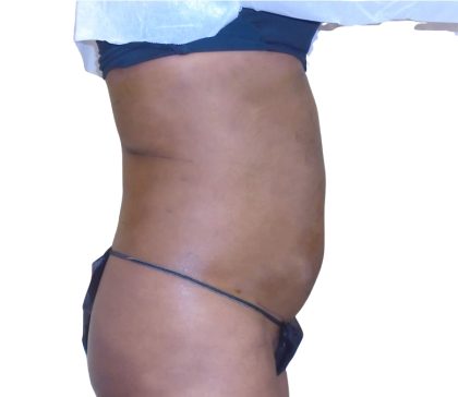 Lipo 360 Before & After Patient #1192