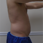 ULF Before & After Patient #1222