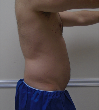 ULF Before & After Patient #1222