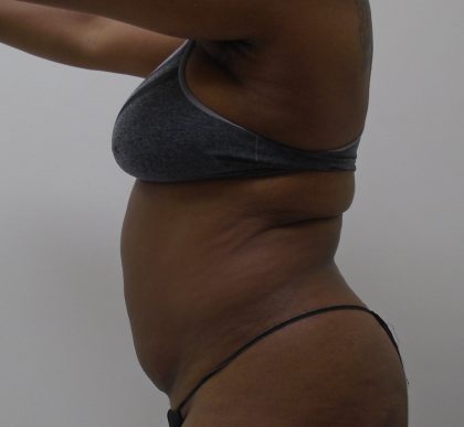 Lipo 360 Before & After Patient #1205