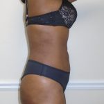 Lipo 360 Before & After Patient #1192