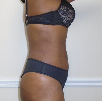 Lipo 360 Before & After Patient #1192