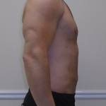 ULF Before & After Patient #1222