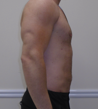 ULF Before & After Patient #1222