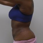 Lipo 360 Before & After Patient #1205