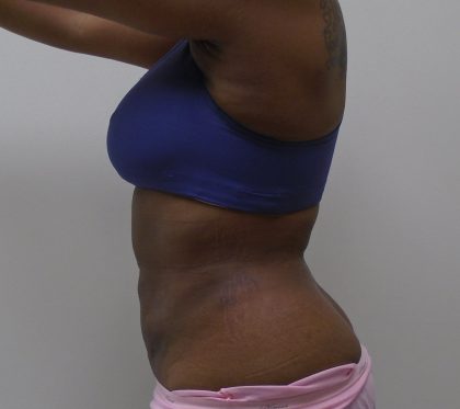 Lipo 360 Before & After Patient #1205