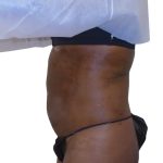 Lipo 360 Before & After Patient #1192