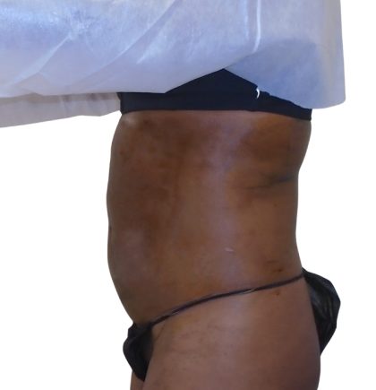 Lipo 360 Before & After Patient #1192