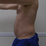 ULF Before & After Patient #1222