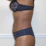 Lipo 360 Before & After Patient #1192