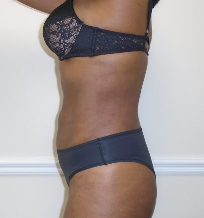 Lipo 360 Before & After Patient #1192
