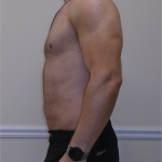 ULF Before & After Patient #1222