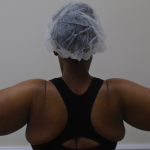 Arm Liposuction Before & After Patient #1258