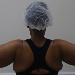 Arm Liposuction Before & After Patient #1258