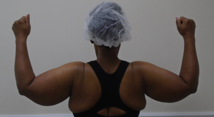 Arm Liposuction Before & After Patient #1258