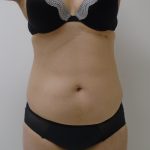 Lipo 360 Before & After Patient #1261