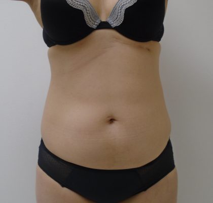 Lipo 360 Before & After Patient #1261