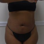 Lipo 360 Before & After Patient #1266