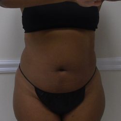Lipo 360 Before & After Patient #1266