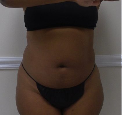 Lipo 360 Before & After Patient #1266