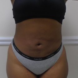 Lipo 360 Before & After Patient #1266