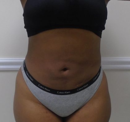 Lipo 360 Before & After Patient #1266
