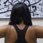 Arm Liposuction Before & After Patient #1258