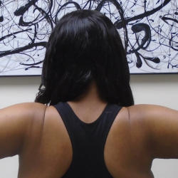 Arm Liposuction Before & After Patient #1258
