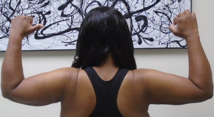 Arm Liposuction Before & After Patient #1258