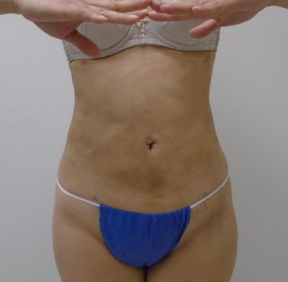 Lipo 360 Before & After Patient #1261