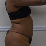 Lipo 360 Before & After Patient #1266