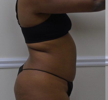 Lipo 360 Before & After Patient #1266
