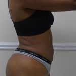 Lipo 360 Before & After Patient #1266