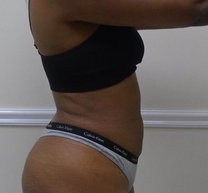 Lipo 360 Before & After Patient #1266