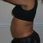 Lipo 360 Before & After Patient #1246