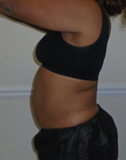 Lipo 360 Before & After Patient #1246