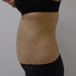 Lipo 360 Before & After Patient #1261