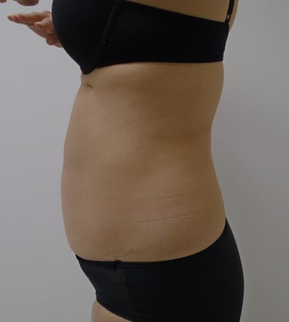 Lipo 360 Before & After Patient #1261