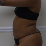 Lipo 360 Before & After Patient #1266