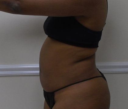 Lipo 360 Before & After Patient #1266
