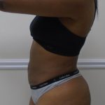 Lipo 360 Before & After Patient #1266