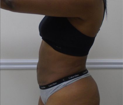 Lipo 360 Before & After Patient #1266