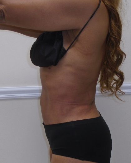 Lipo 360 Before & After Patient #1246